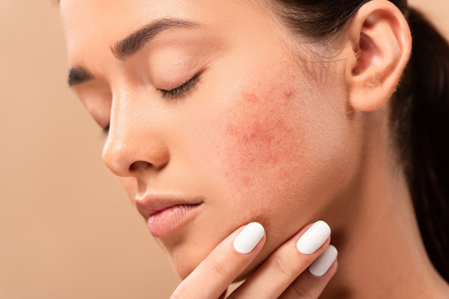 Girl with acne 