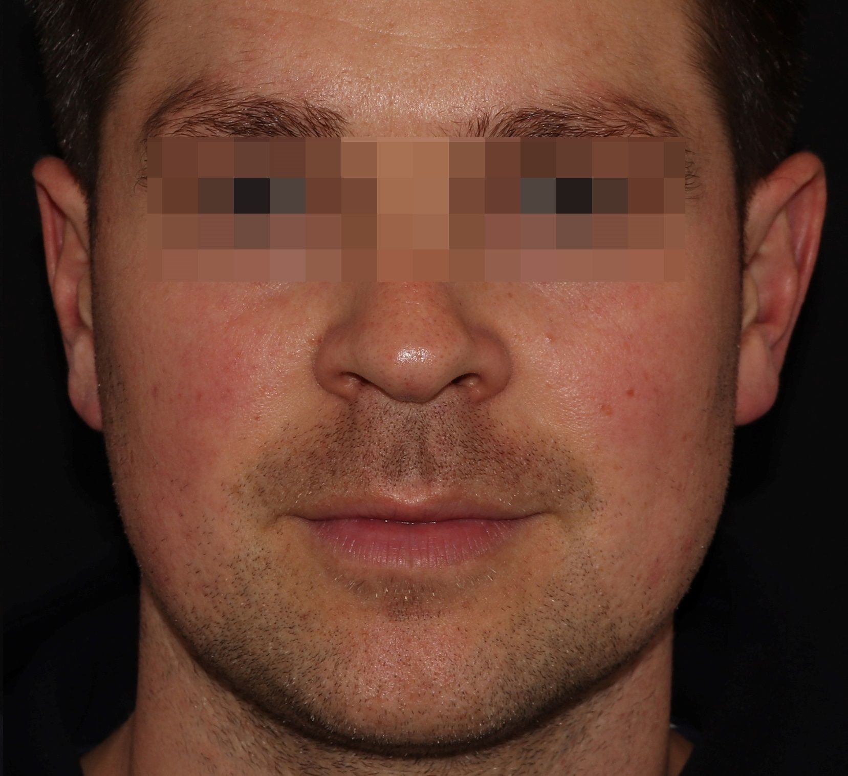 Facial Redness After.jpg