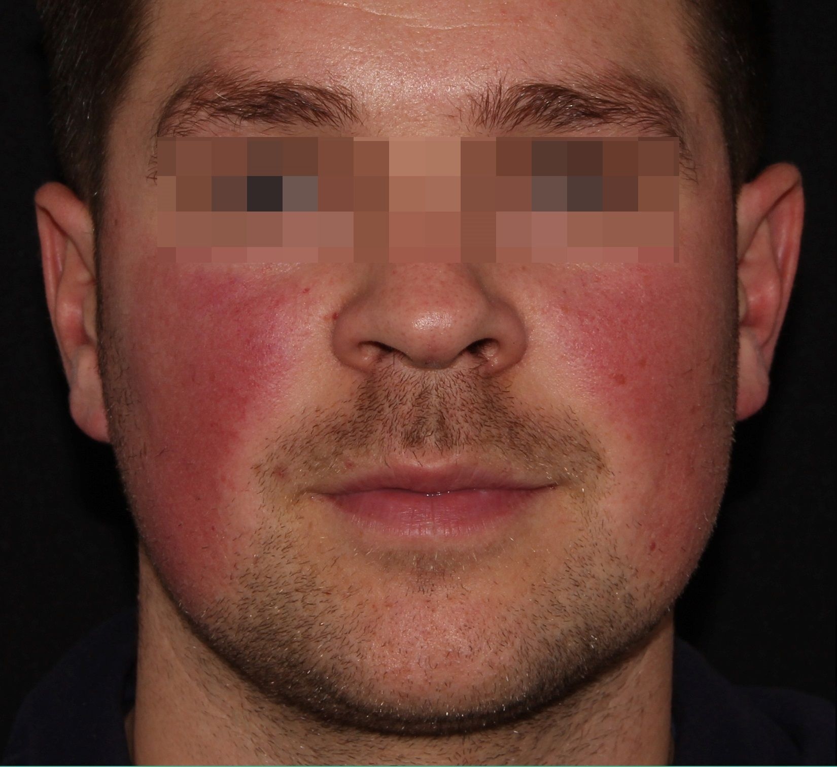Facial Redness Before.jpg