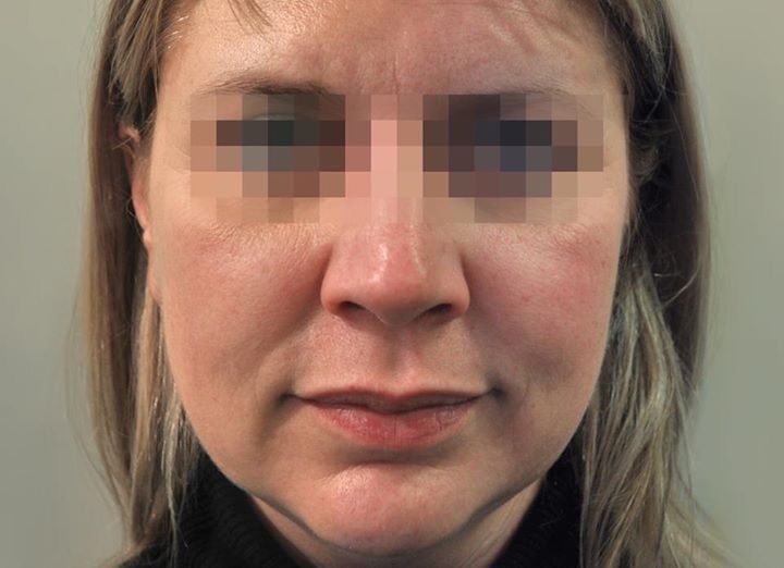 Profhilo Face Before