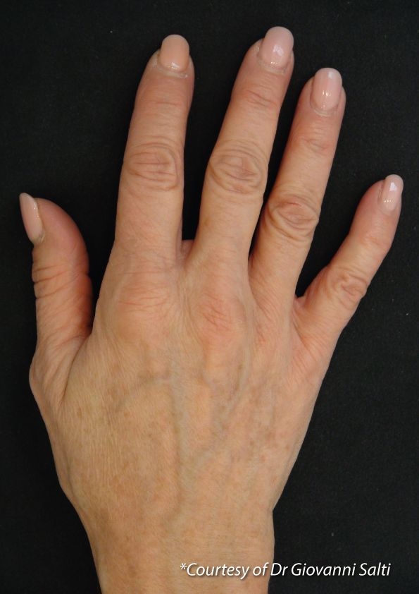 Profhilo Hand After