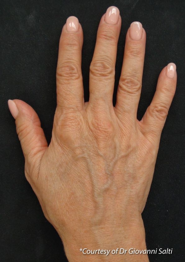 Profhilo Hand Before