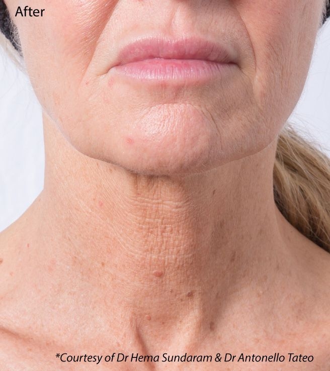 Profhilo Neck After