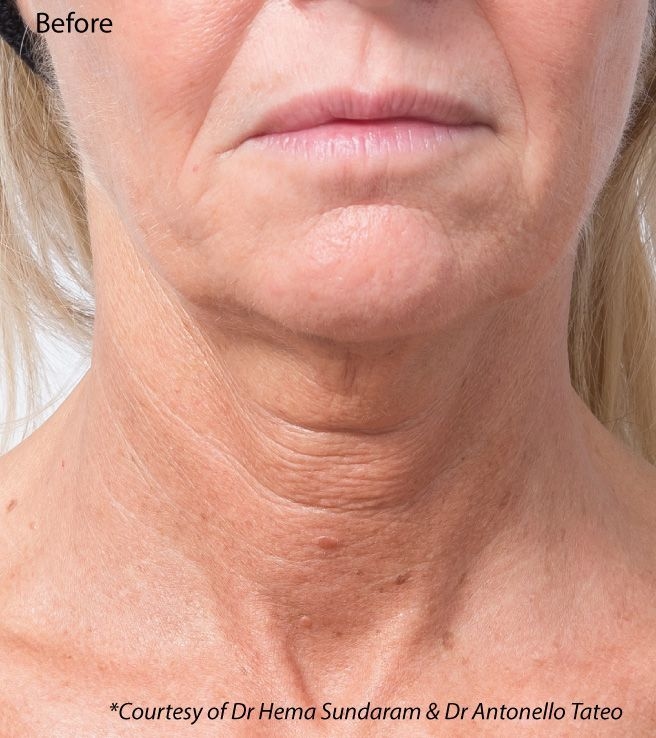 Profhilo Neck Before