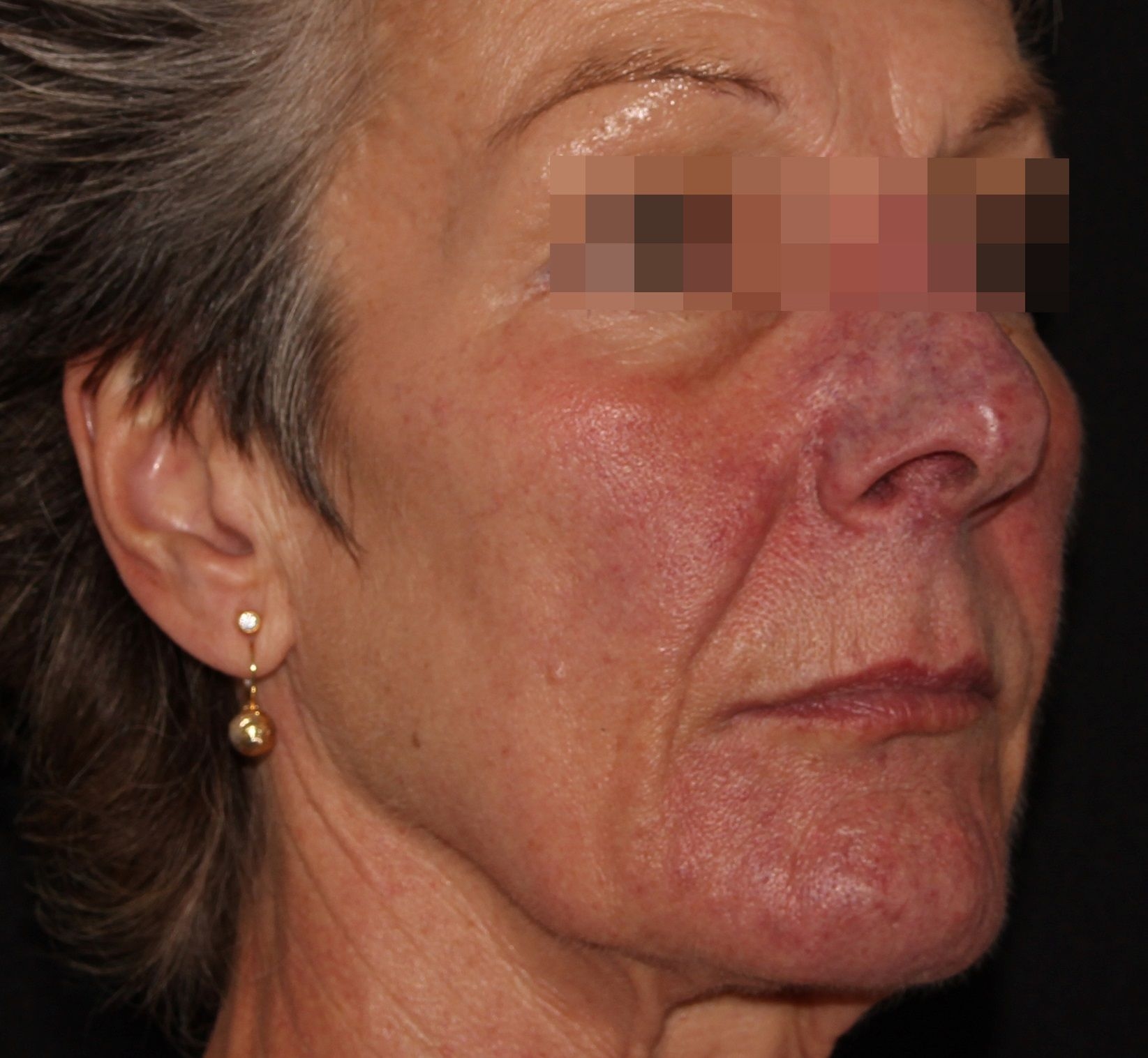Rosacea Before.jpg
