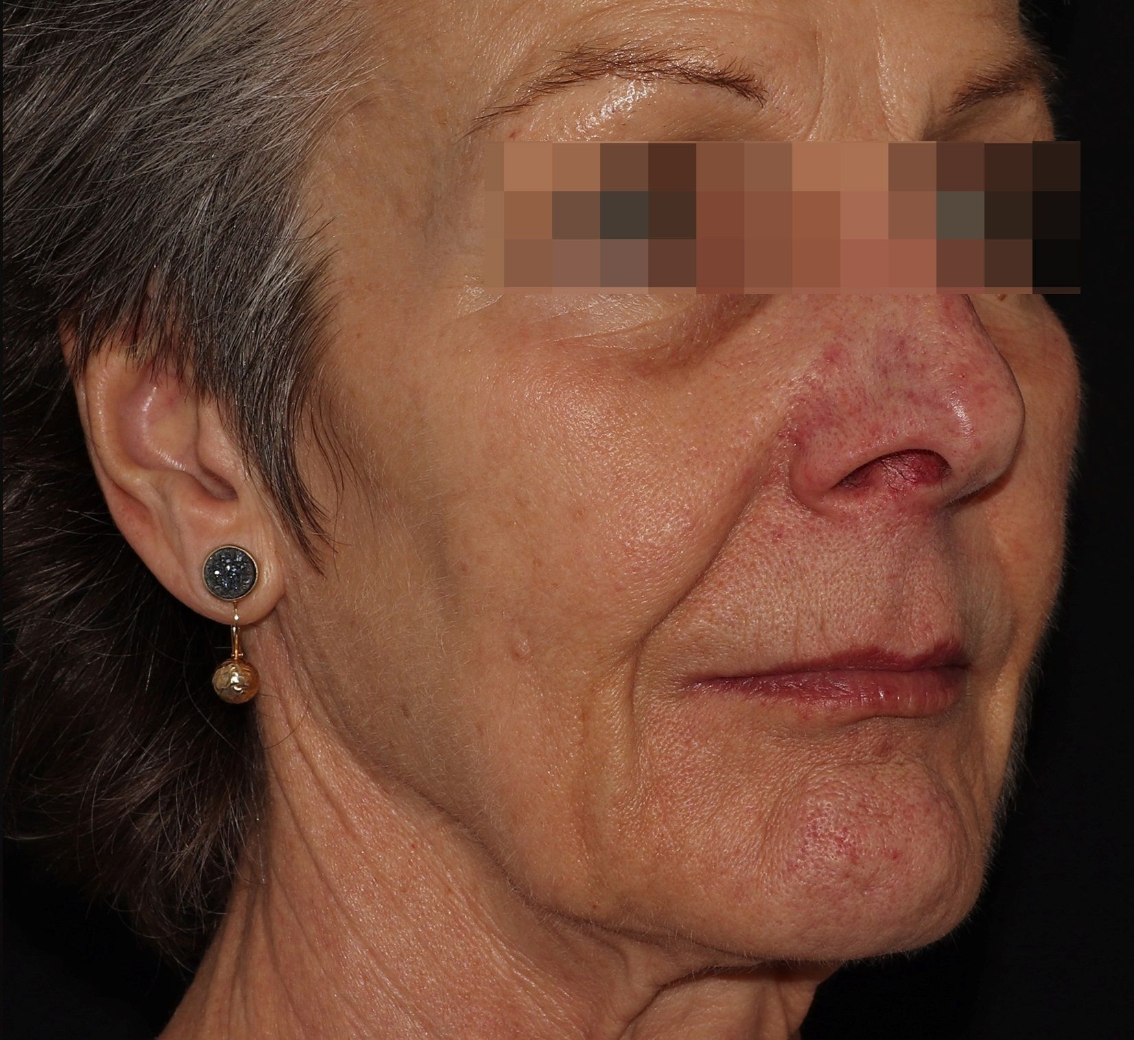 Rosacea  after.jpg