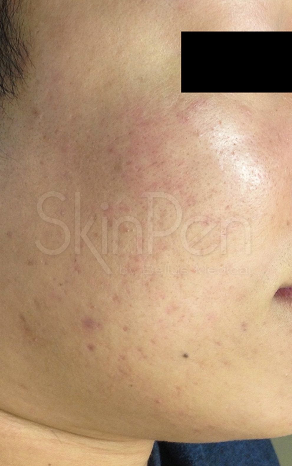 Skin Pen After 1.jpg
