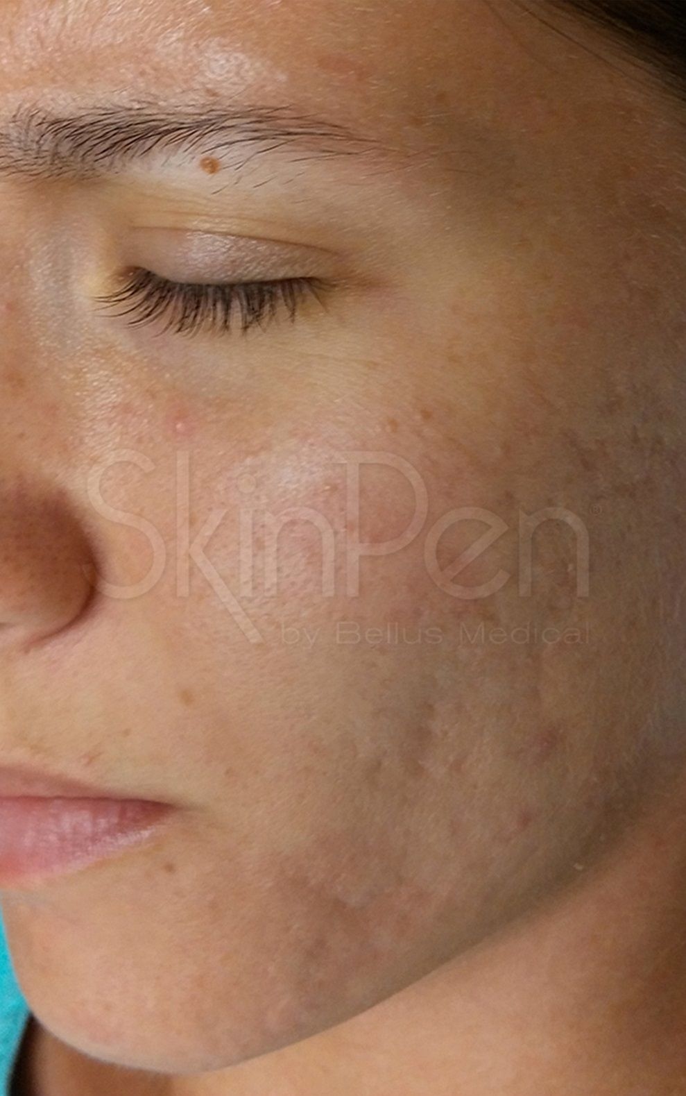 Skin Pen After 2.jpg