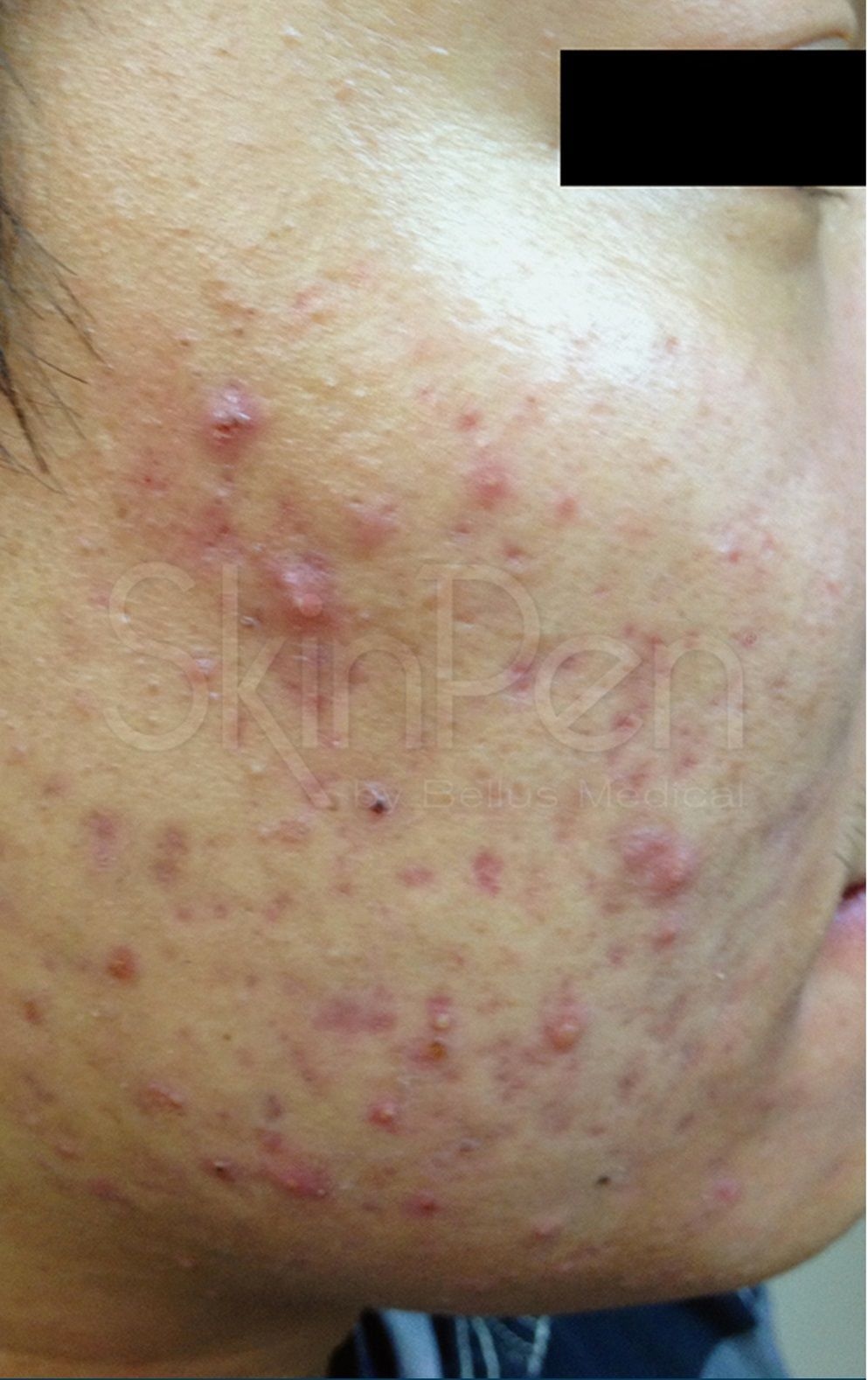 Skin Pen Before 1.jpg