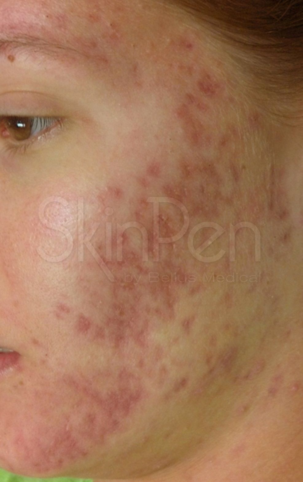 Skin Pen Before 2.jpg