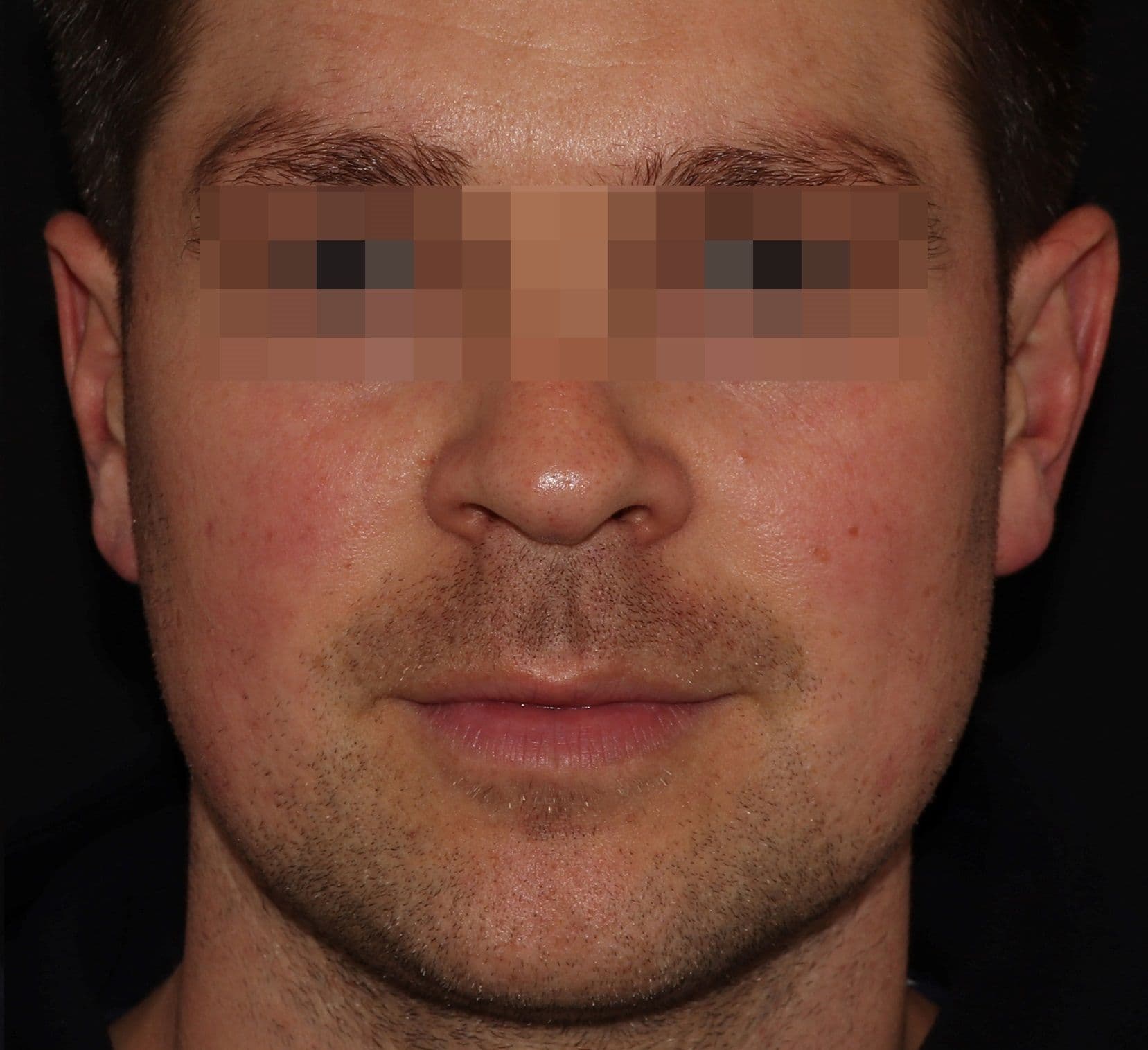 Facial Redness After.jpg
