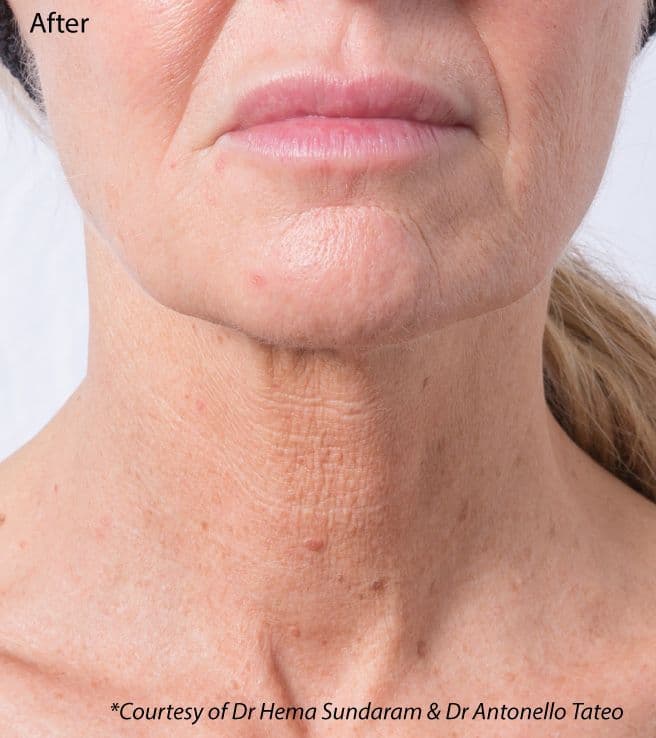 Profhilo Neck After