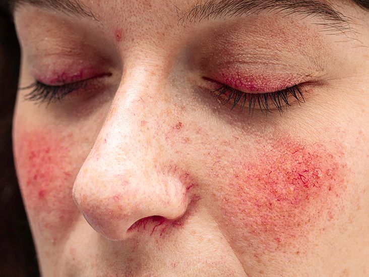 Rosacea